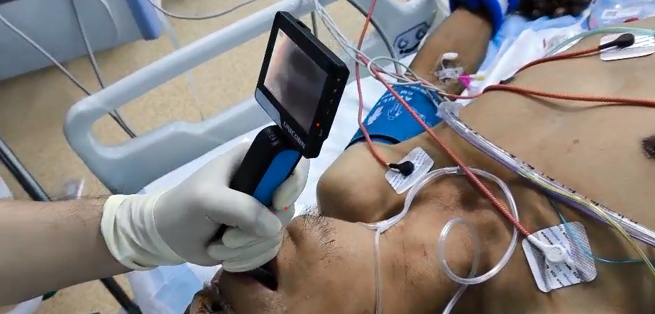 Unicorn laryngoscope application in anesthesia and respiratory departments