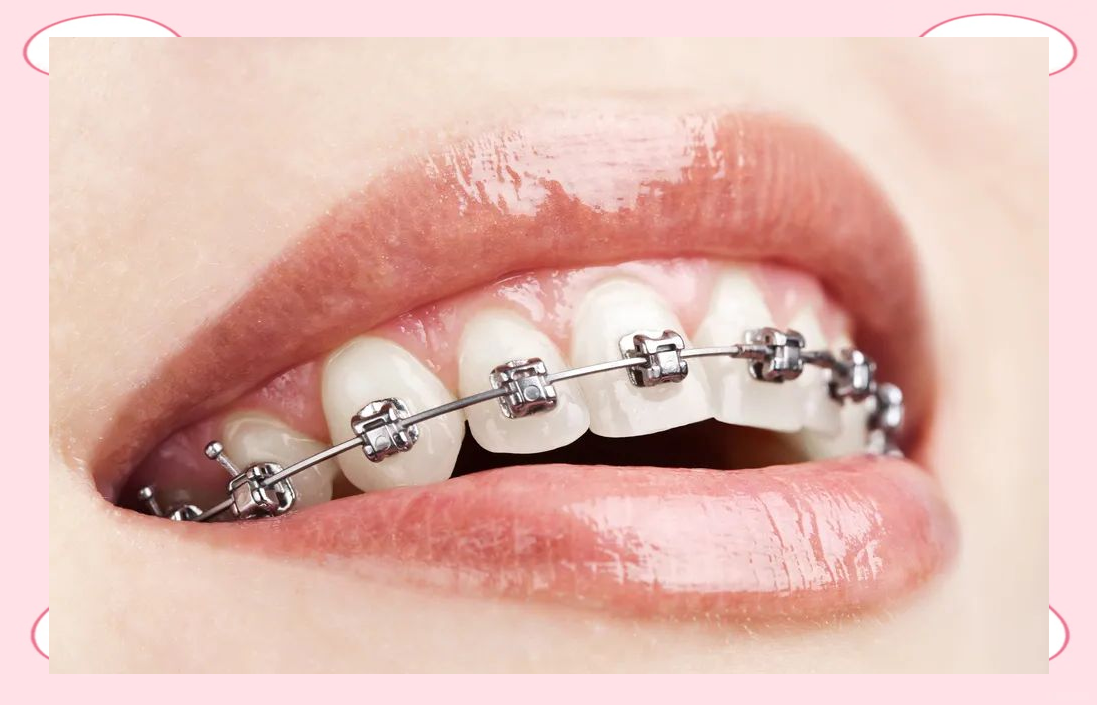 Orthodontic applications using Nitinol and titanium materials