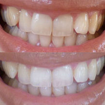 teeth whitening strips before and after stain removal
