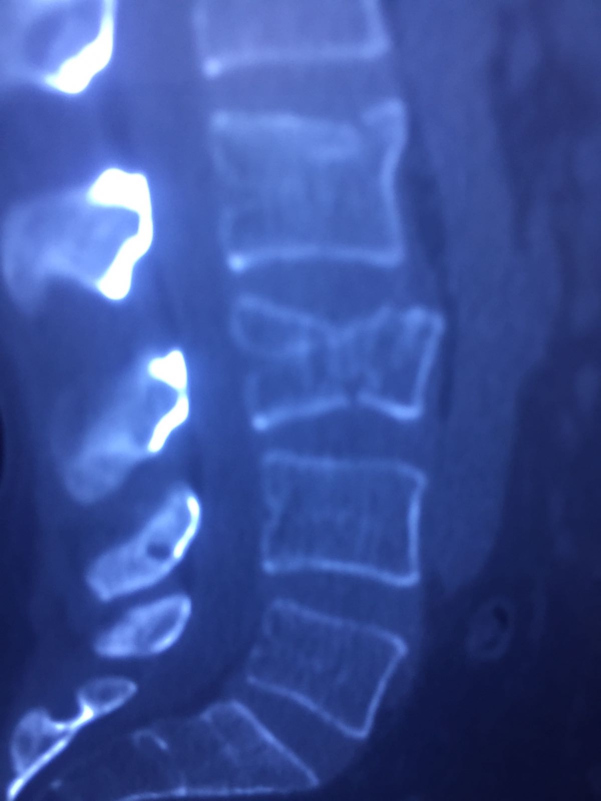 Intraoperative fluoroscopic image of the egg-shell technique in balloon kyphoplasty