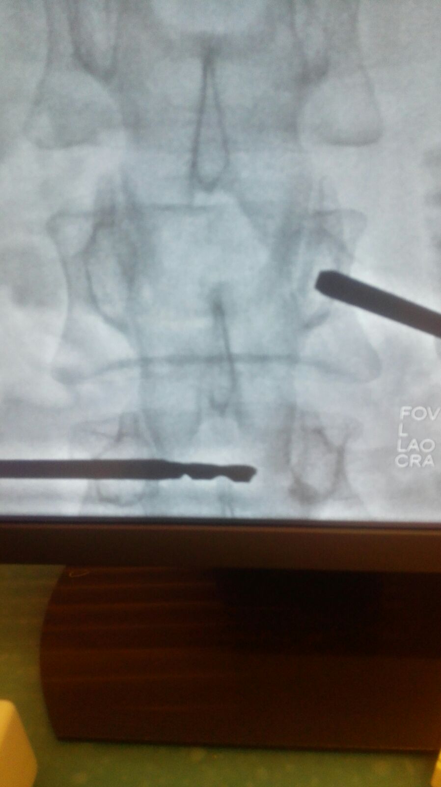 Vertebral compression fracture case managed with the egg shell technique in a minimally invasive spine procedure