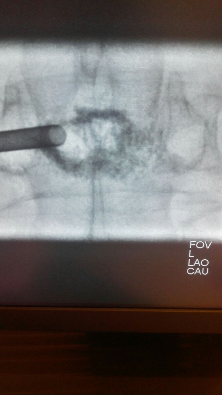 Egg shell technique kyphoplasty case reference used for procurement scenario planning