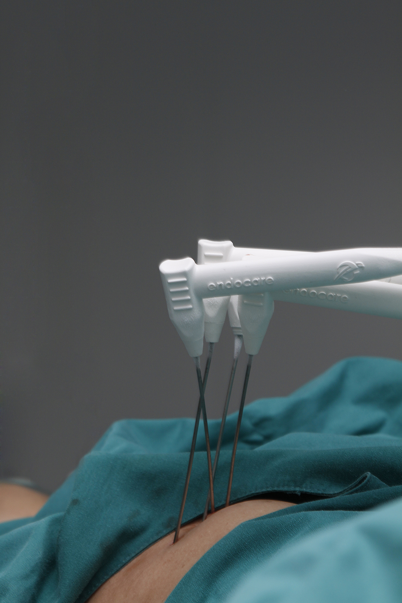 Cryoablation procedure step within a non-surgical cancer treatment pathway
