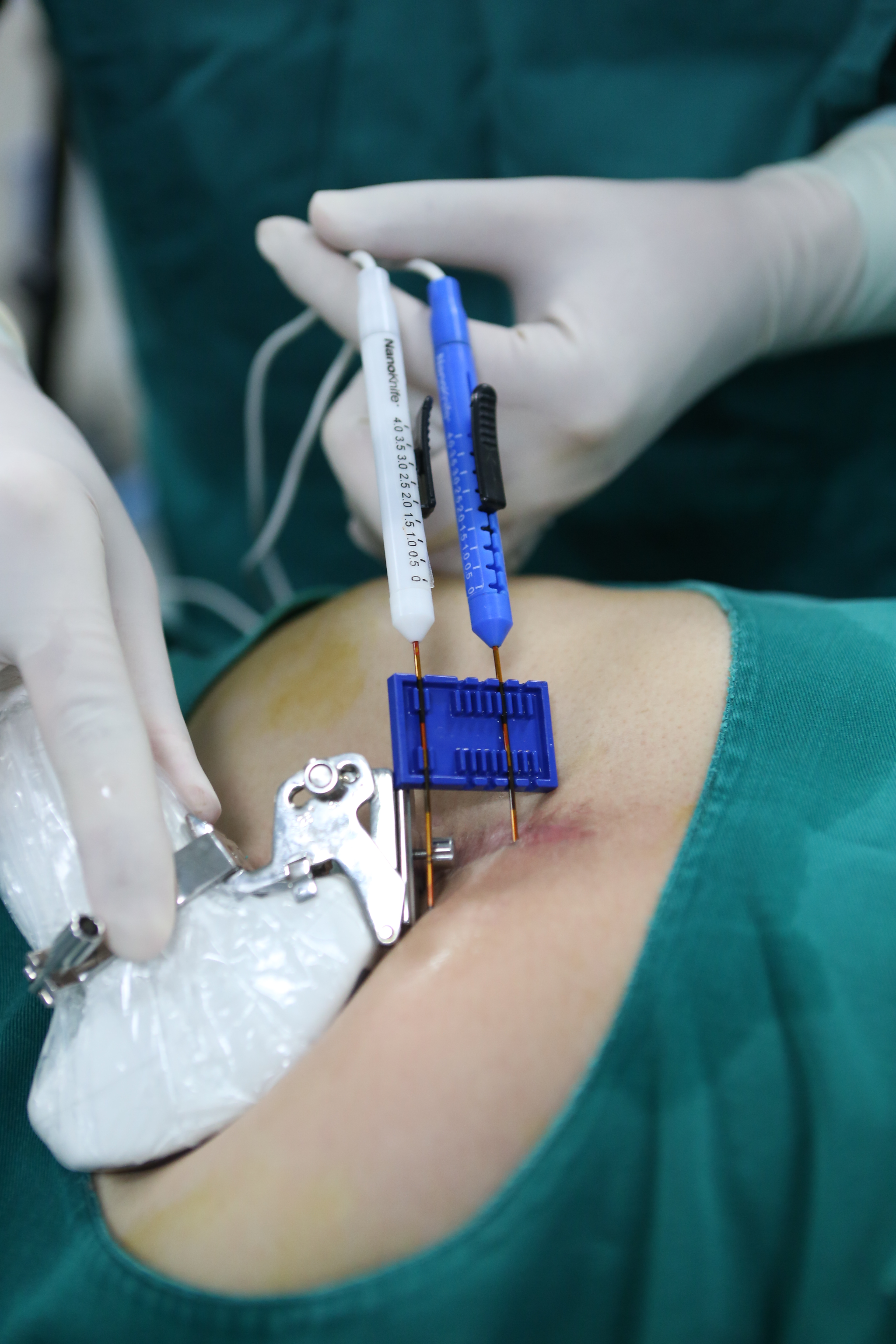 NanoKnife irreversible electroporation system used for single-needle S-IRE tumor ablation at Fuda Cancer Hospital