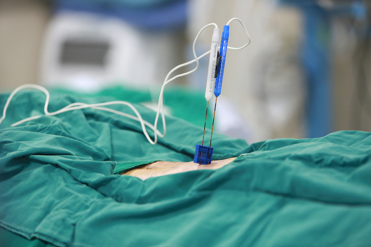 Fuda NanoKnife irreversible electroporation system used at an interventional cancer treatment hospital