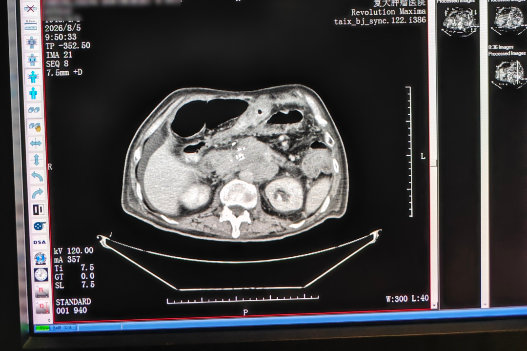 CT image before treatment Pre-treatment CT image from a documented single-needle nanoknife ablation case