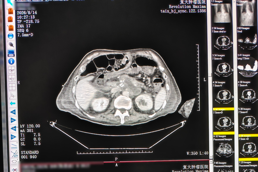 CT image after treatment Post-treatment CT image taken the day after single-needle nanoknife ablation