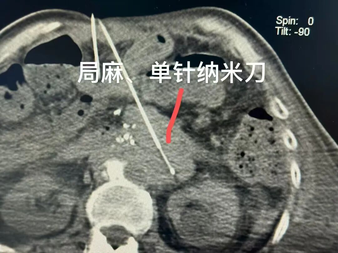 Ablation procedure for a recurrent pancreatic lesion using single-needle irreversible electroporation