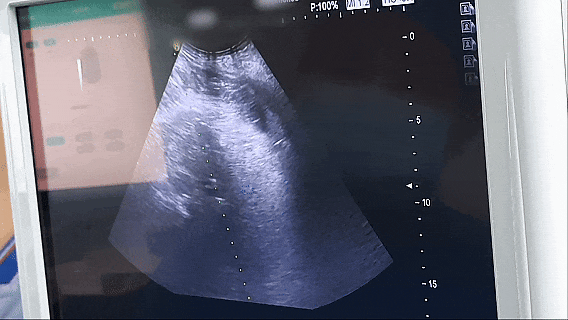 CT and ultrasound guided single-needle bipolar nanoknife ablation procedure for recurrent pancreatic cancer at Fuda Cancer Hospital