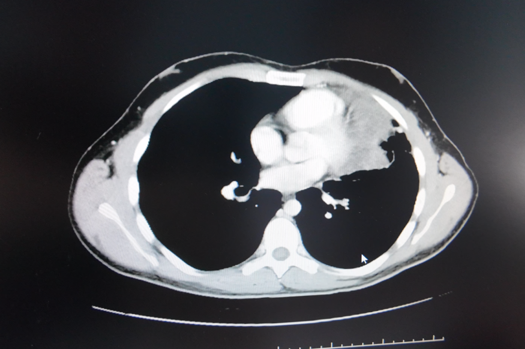 Serial CT follow-up showing gradual shrinkage of a Ewing sarcoma lung metastasis after interventional treatment