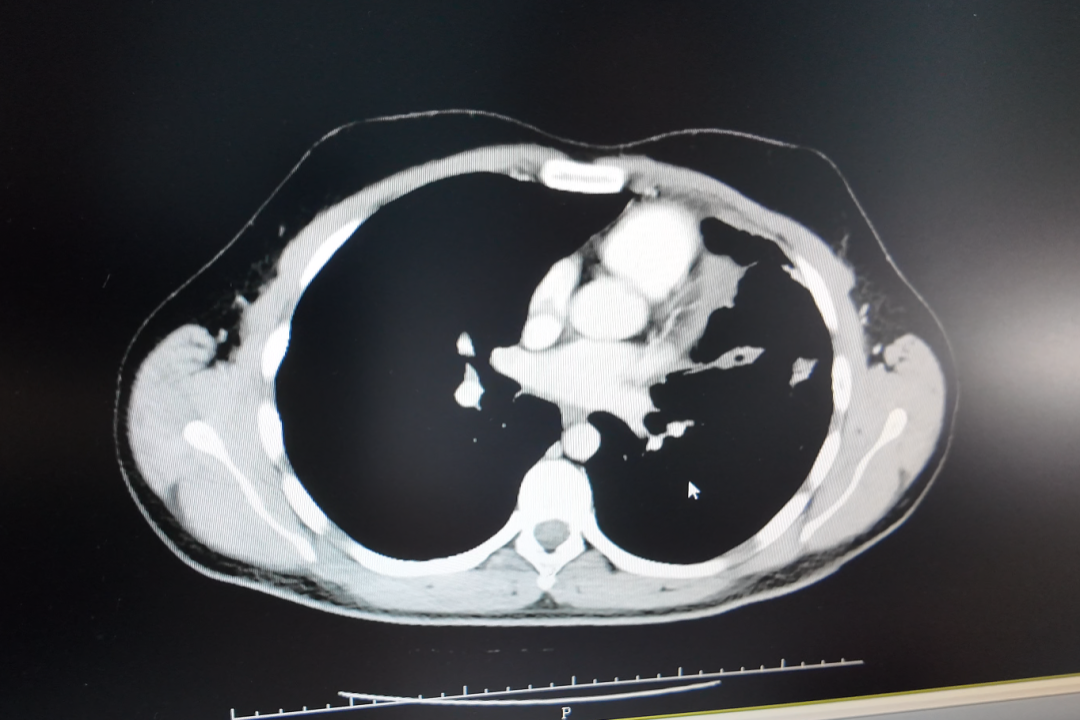 Follow-up imaging comparison Follow-up CT comparison of a 17 cm Ewing sarcoma lung metastasis after minimally invasive treatment