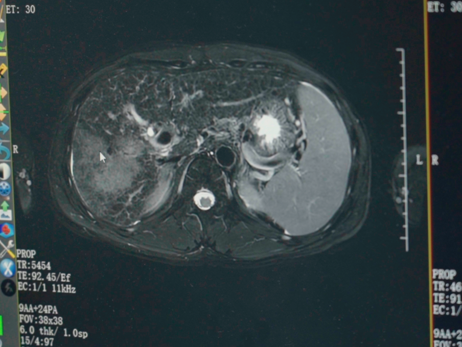 Comparison imaging after two HAIC sessions in the same liver cancer case