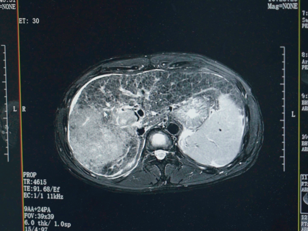 Baseline imaging on admission for a late-stage liver cancer patient