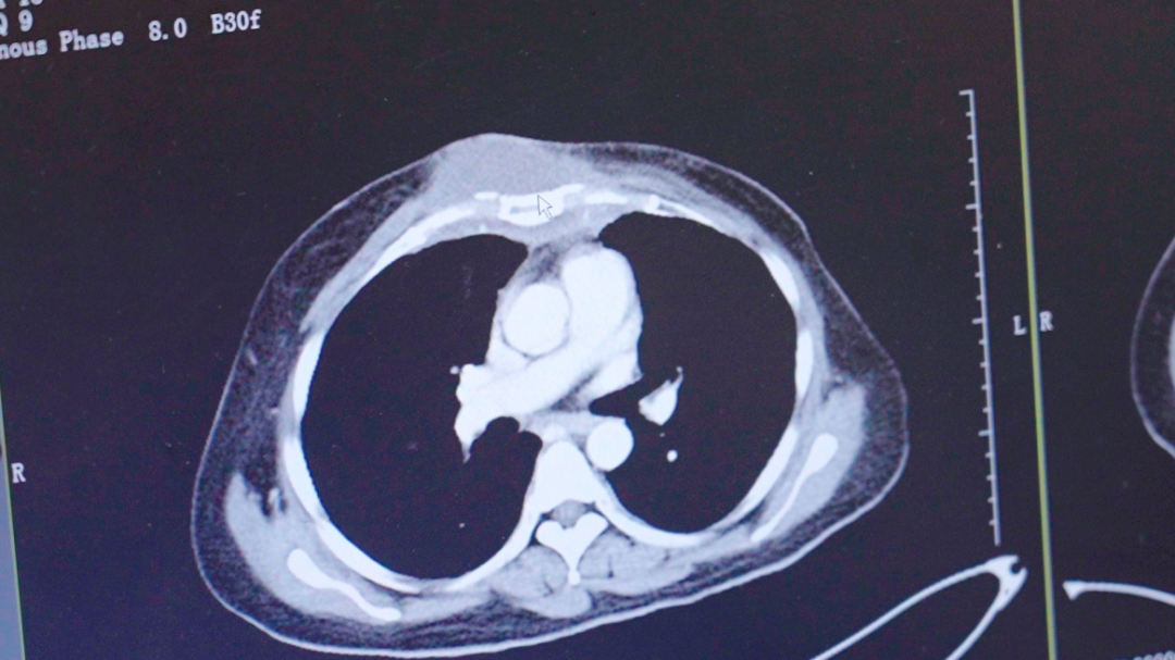 Chest wall and sternal metastases after combined interventional treatment in metastatic triple-negative breast cancer
